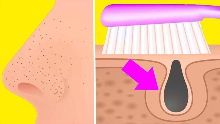 This simple home remedy clears blackheads in minutes… try it today!