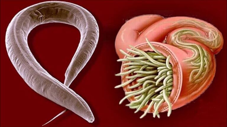 5 Powerful Remedies to Eliminate Parasites Fast and Naturally!