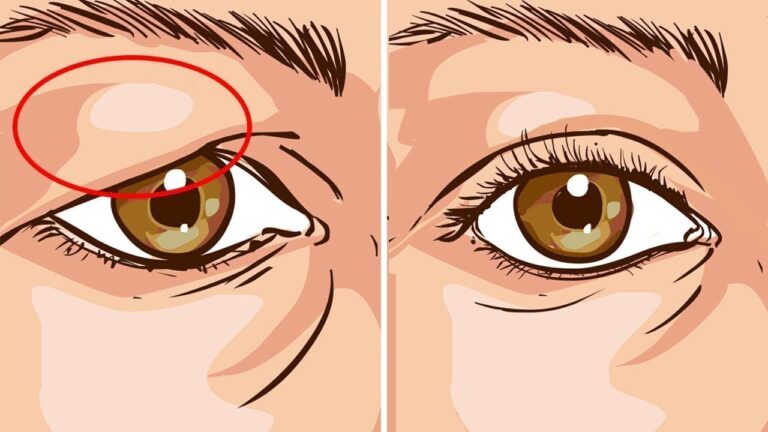 5 Natural Remedies to Treat Droopy Eyelids You Need to Try