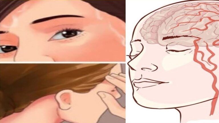 7 Warning Signs You Might Ignore Days Before a Stroke