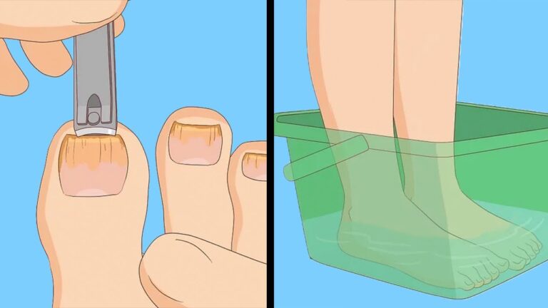Say Goodbye to Nail Fungus: 5 Daily Habits for Healthy Nails