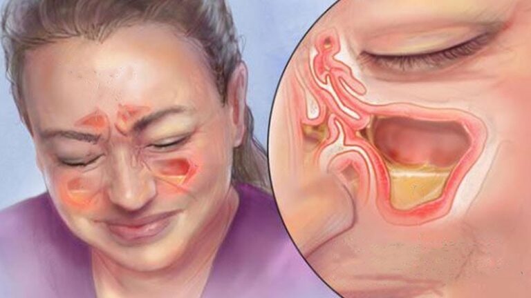 7 Easy Ways to Relieve Sinusitis Fast and Naturally!