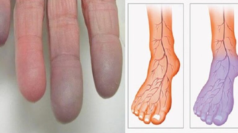 7 Natural Remedies to Improve Poor Circulation Fast!