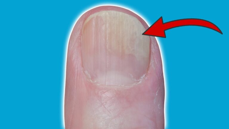 5 Simple Home Remedies to Solve Your Nail Problems Fast and Easy!